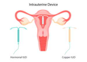 What Is an IUD?