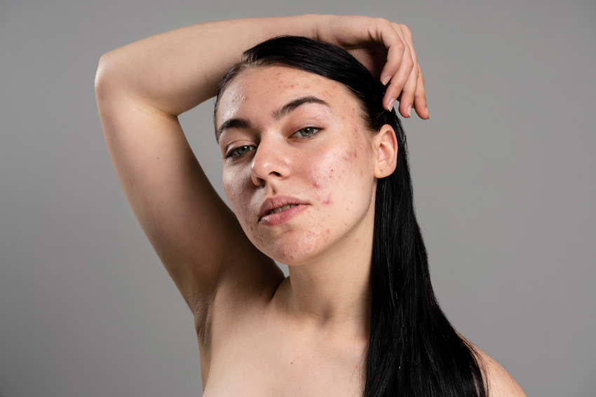 Young Woman showing her Acne with Confidence