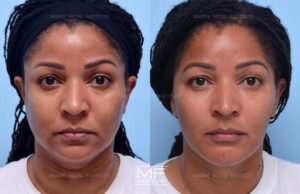 before and after juvederm