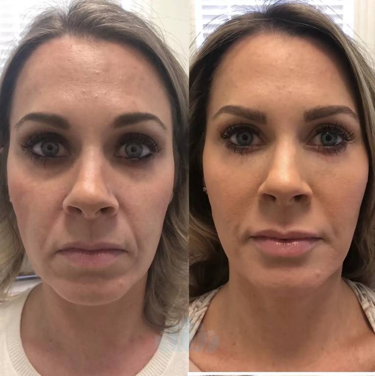 juvederm jowls before and after 1