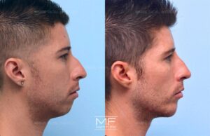 sagging jowls before and after