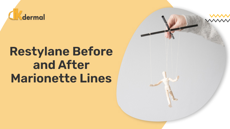 Restylane Before and After Marionette Lines
