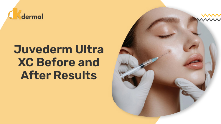 Juvederm Ultra XC Before and After Results