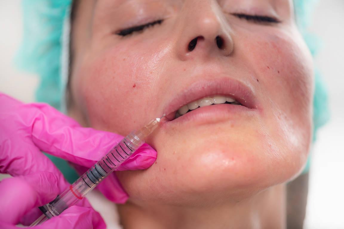 Long-Term Effect of Fillers