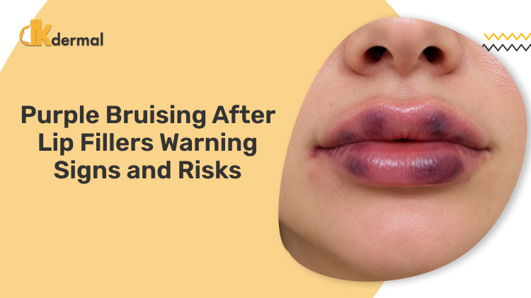 Purple Bruising After Lip Fillers Warning Signs and Risks